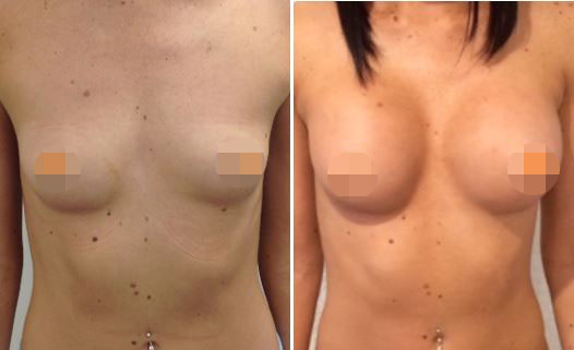 Breast Augmentation CosMediTour