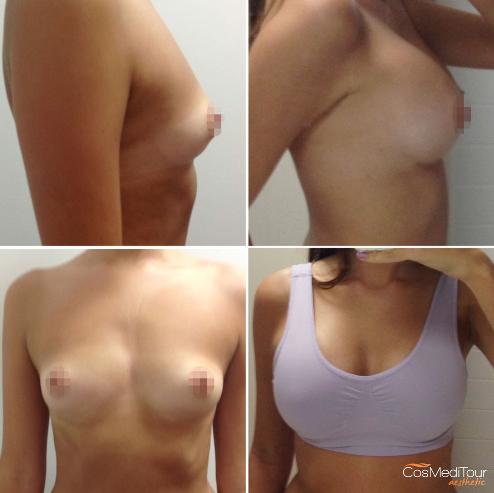 Breast Augmentation Before & After #40