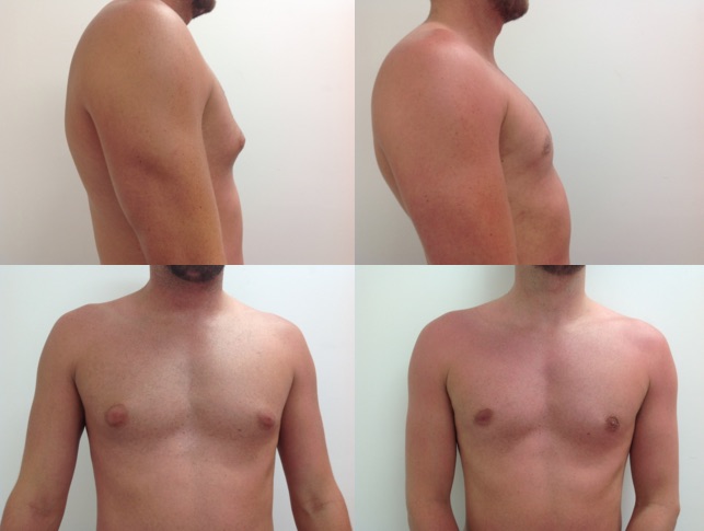 Self esteem was the biggest factor pushing me to get this surgery