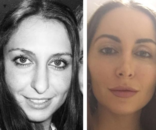 Phuket Rhinoplasty transformation