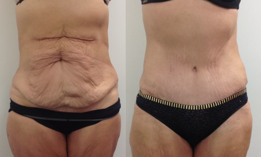 Judith-tummy-tuck-before-after (1)
