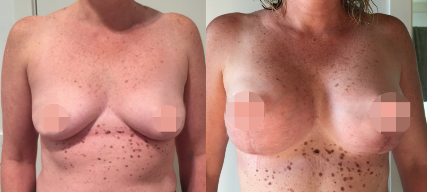 197216381-2 Breast Augmentation CosMediTour